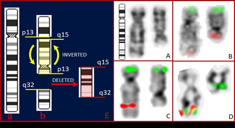 A treatment-refractory aggressive MDS-MLD with multiple highly complex chromosome 5 intrachromosomal rearrangements: a case report.