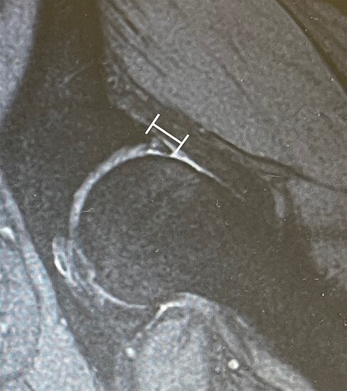 Relationship between labral length and symptoms in patients with acetabular dysplasia before rotational acetabular osteotomy.