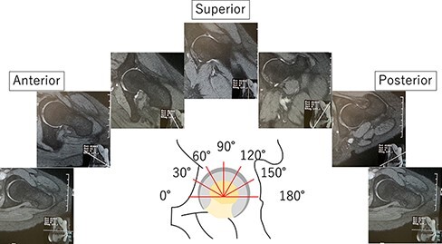 Relationship between labral length and symptoms in patients with acetabular dysplasia before rotational acetabular osteotomy.