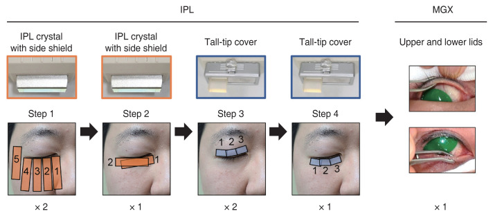 Different Number of Sessions of Intense Pulsed Light and Meibomian Gland Expression Combination Therapy for Meibomian Gland Dysfunction.