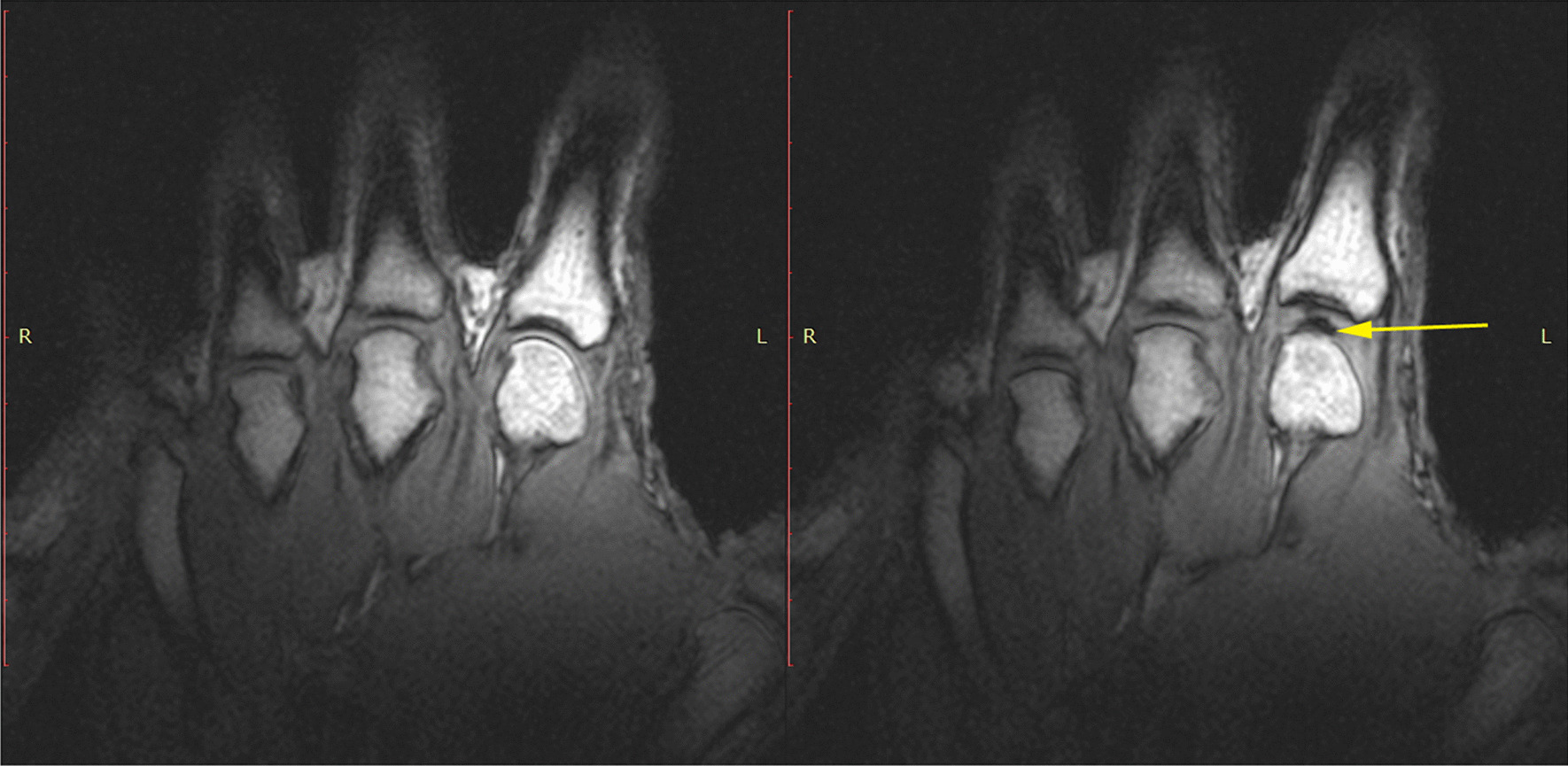 Why is the prevailing model of joint manipulation (still) incorrect?