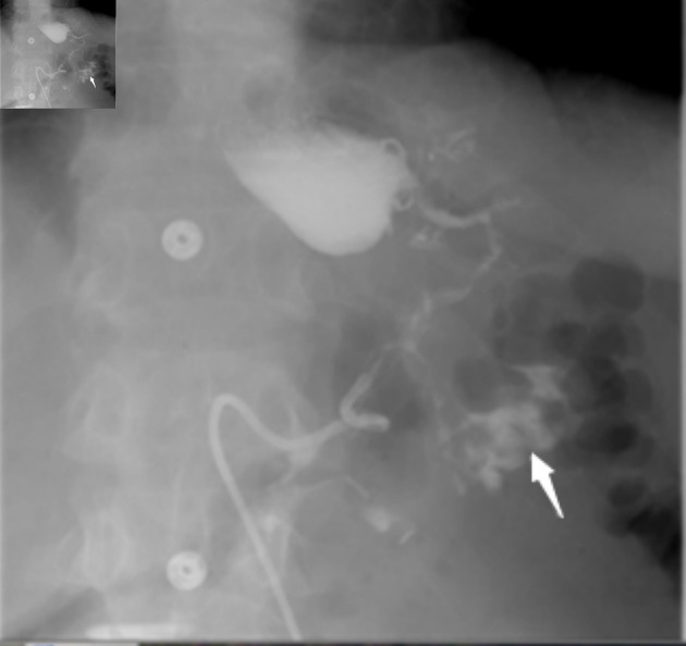 Gastrocolic Fistula: An Extraordinary Gastrointestinal Fistula.