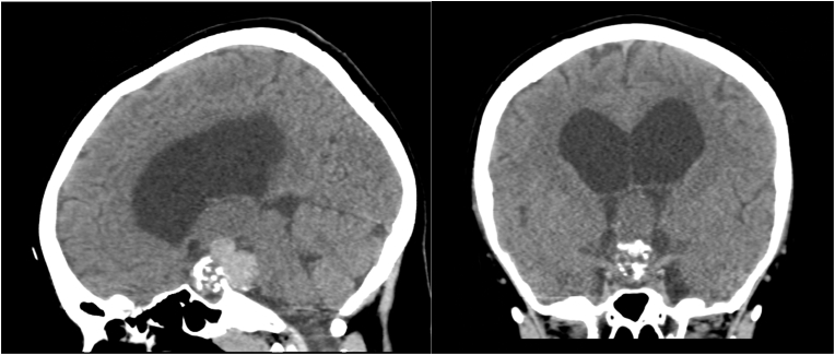 Clinical characterization of pediatric supratentorial tumors and prediction of pituitary insufficiency in two tertiary centers in Saudi Arabia