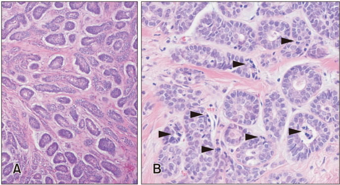 A Case of Malignant Transformation of Solitary Recurrent Cylindroma on Scalp.