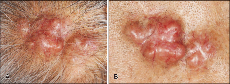 A Case of Malignant Transformation of Solitary Recurrent Cylindroma on Scalp.