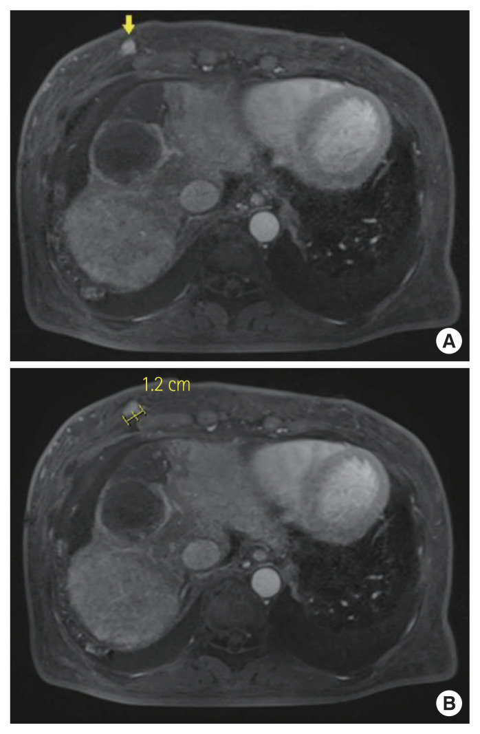 Metastatic breast cancer from a hepatocellular carcinoma: a case report.