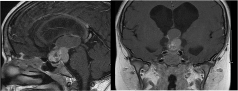 Clinical characterization of pediatric supratentorial tumors and prediction of pituitary insufficiency in two tertiary centers in Saudi Arabia