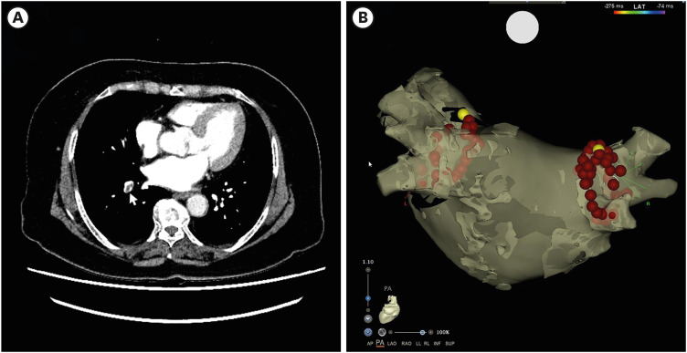 A case of sinus arrest in atrial fibrillation with pulmonary embolism after flecainide ingestion.