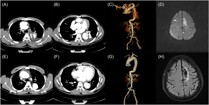 Repair of ATAAD with a 3D-printing assisted pre-windowed coated stent: A case report.