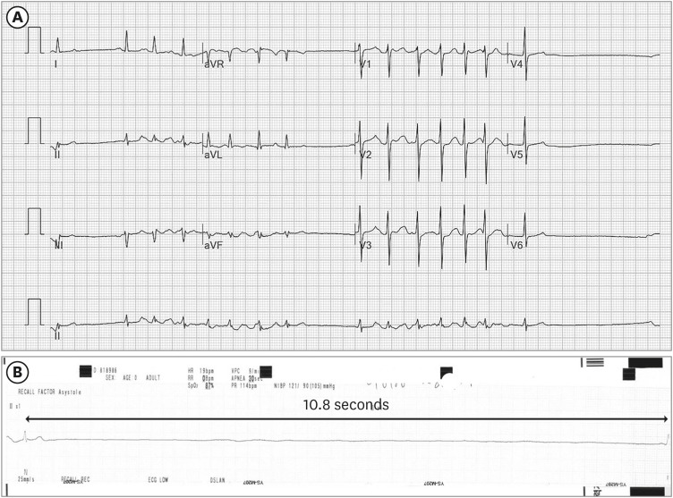 A case of sinus arrest in atrial fibrillation with pulmonary embolism after flecainide ingestion.