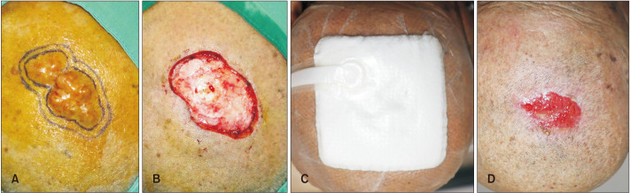 A Case of Malignant Transformation of Solitary Recurrent Cylindroma on Scalp.