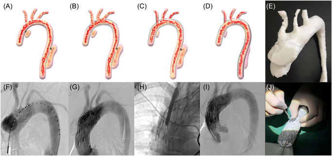 Repair of ATAAD with a 3D-printing assisted pre-windowed coated stent: A case report.