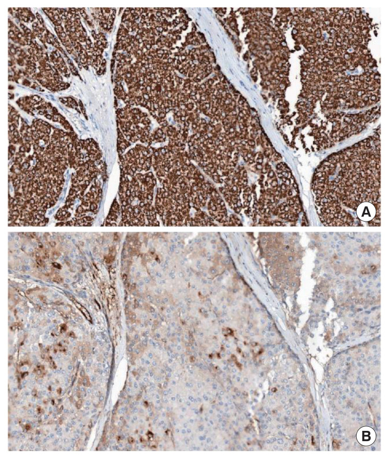 Metastatic breast cancer from a hepatocellular carcinoma: a case report.