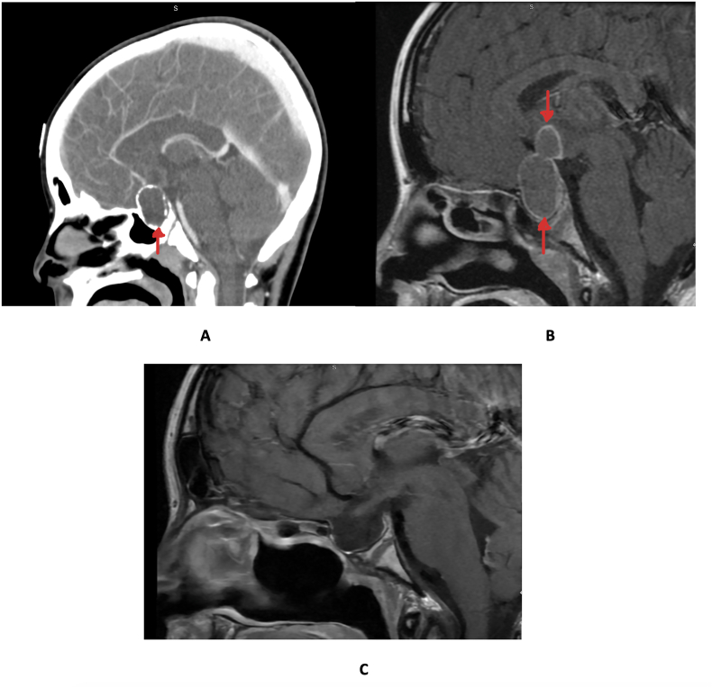 Clinical characterization of pediatric supratentorial tumors and prediction of pituitary insufficiency in two tertiary centers in Saudi Arabia