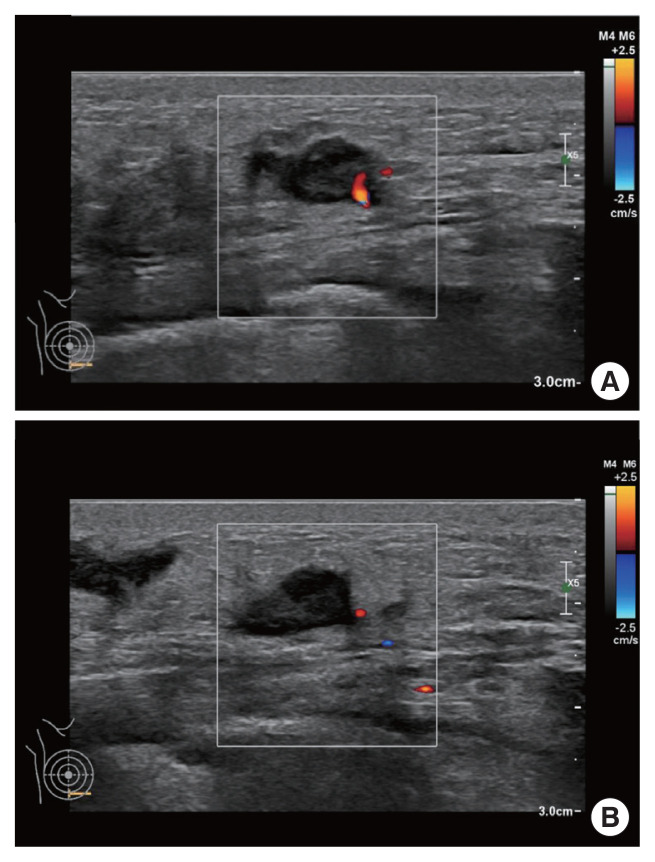 Metastatic breast cancer from a hepatocellular carcinoma: a case report.