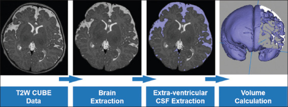 Coronal T2-weighted imaging improves the measurement accuracy of the subarachnoid space in infants: A descriptive study.