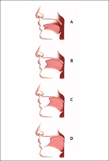 Role of functional and anatomic study in sleep endoscopy for treatment of OSA.