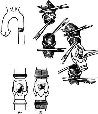 The dawn of surgical treatment of aortic insufficiency.