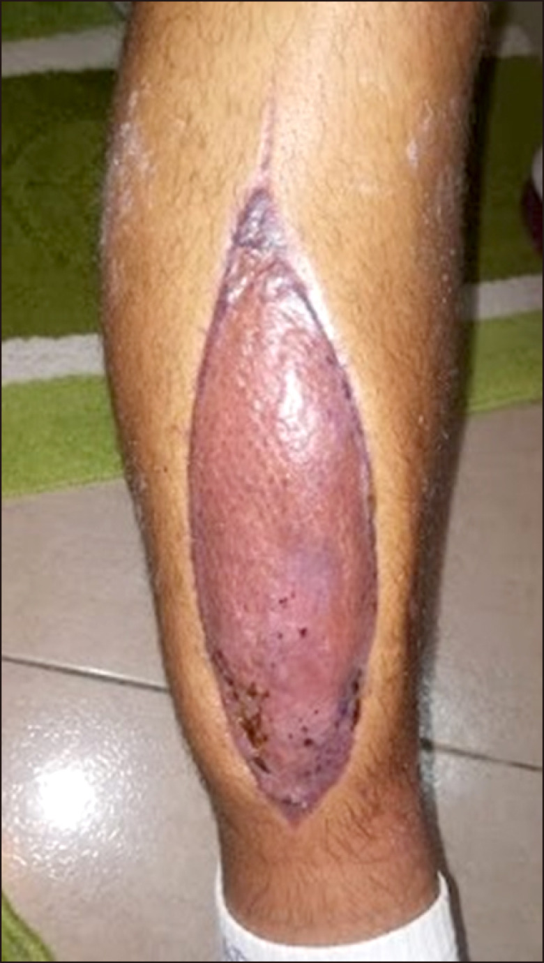 Rapid development of lower leg compartment syndrome following firearm injury in a patient with moderate hemophilia B.