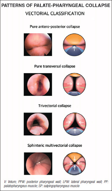 Role of functional and anatomic study in sleep endoscopy for treatment of OSA.