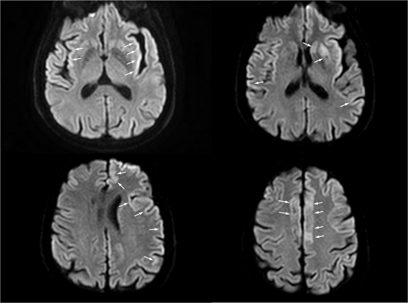 Penetrance of the V203I variant of the PRNP gene: report of a patient with stroke-like onset of Creutzfeld-Jacob Disease and review of published cases.