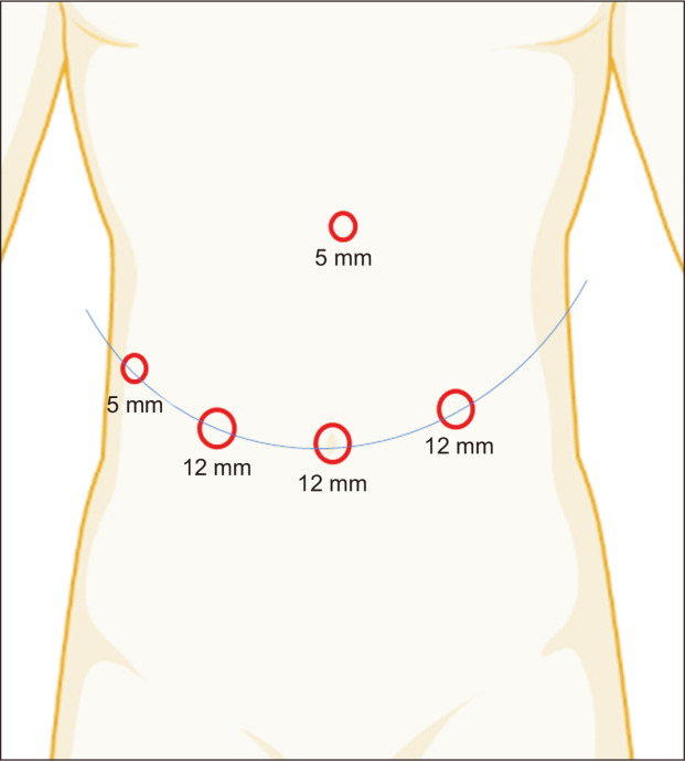 Usefulness of the new articulating laparoscopic instrument in laparoscopic pancreaticoduodenectomy.