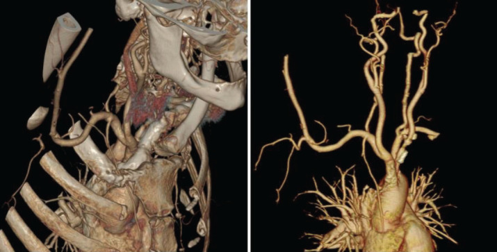 Subclavian Steal Syndrome Caused by Thrombosis Associated with COVID-19: a Case Report.