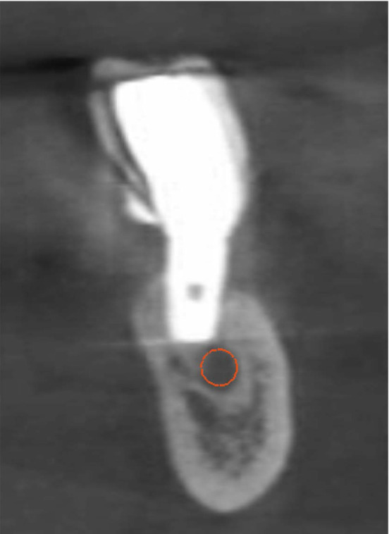 Prevalence of dental implant positioning errors: A cross-sectional study.