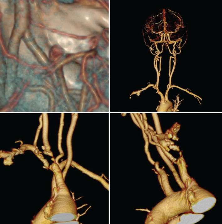 Subclavian Steal Syndrome Caused by Thrombosis Associated with COVID-19: a Case Report.