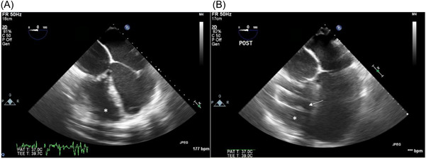 HeartMate 3 implantation for dextro-transposition of the great arteries after Mustard procedure: A technique of papillary muscle repositioning.