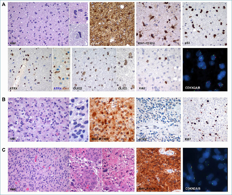 Adult type diffuse gliomas in the new 2021 WHO Classification.