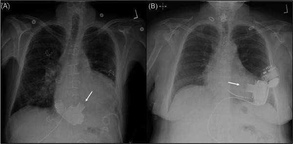 HeartMate 3 implantation for dextro-transposition of the great arteries after Mustard procedure: A technique of papillary muscle repositioning.