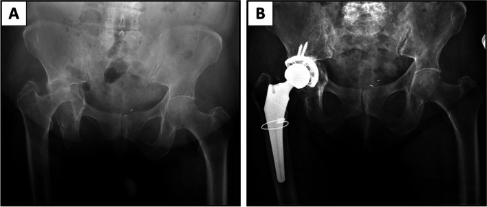 Outcomes of novel 3D-printed fully porous titanium cup and a cemented highly cross-linked polyethylene liner in complex and revision total hip arthroplasty.