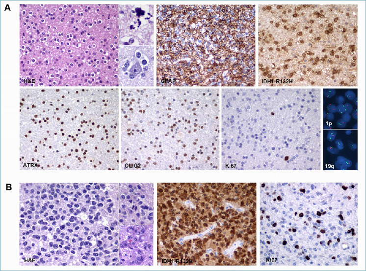 Adult type diffuse gliomas in the new 2021 WHO Classification.