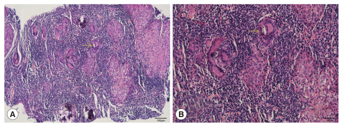 Ectopic Schistosomiasis Involving Axillary Lymph Nodes.