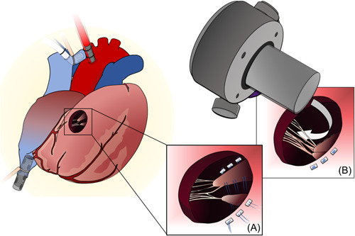 HeartMate 3 implantation for dextro-transposition of the great arteries after Mustard procedure: A technique of papillary muscle repositioning.