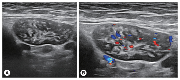 Ectopic Schistosomiasis Involving Axillary Lymph Nodes.