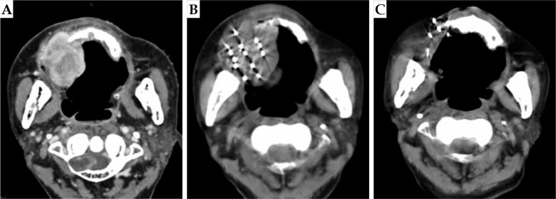 A retrospective study on unresectable or inoperable head and neck cancers treated with stereotactic ablative brachytherapy.