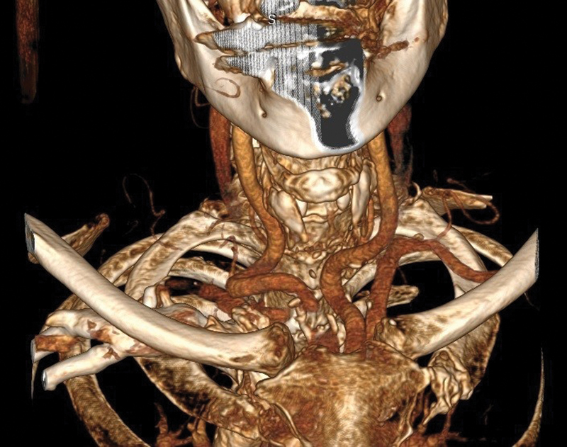 Dolichoarteriopathy of Common Carotid Artery: An Unusual Entity.