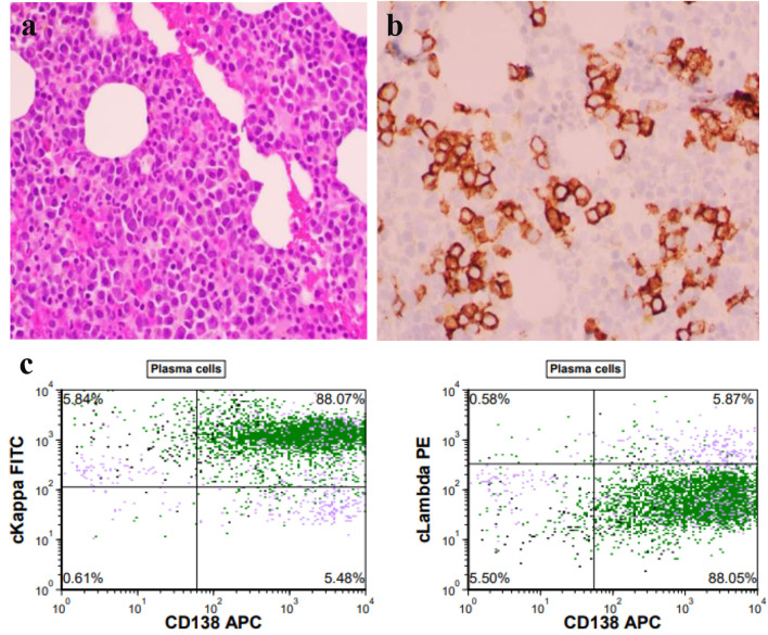 Synchronous Presentation of Autoimmune Hepatitis and Multiple Myeloma.