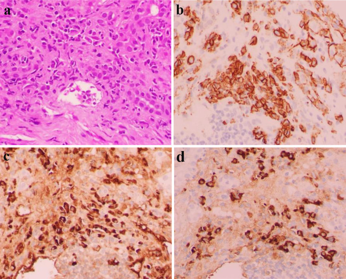 Synchronous Presentation of Autoimmune Hepatitis and Multiple Myeloma.