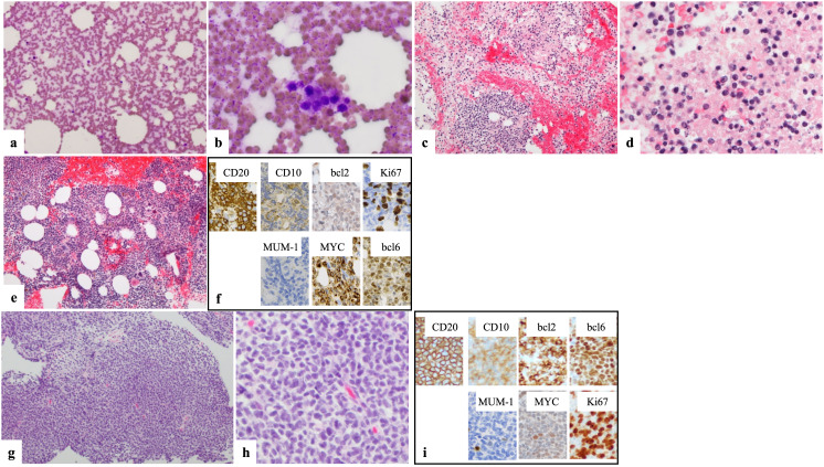 Two cases of follicular lymphoma with MYC gene abnormalities that presented with bone marrow necrosis.