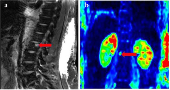 Synchronous Presentation of Autoimmune Hepatitis and Multiple Myeloma.