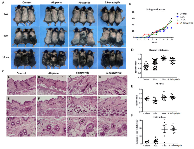 <i>Stauntonia hexaphylla</i> Extract Ameliorates Androgenic Alopecia by Inhibiting Androgen Signaling in Testosterone-induced Alopecia Mice.