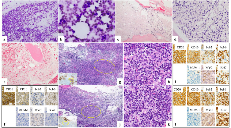 Two cases of follicular lymphoma with MYC gene abnormalities that presented with bone marrow necrosis.