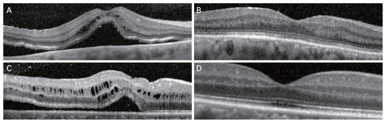 Preoperative and Postoperative Factors Affecting Functional Success in Anatomically Successful Retinal Detachment Surgery.