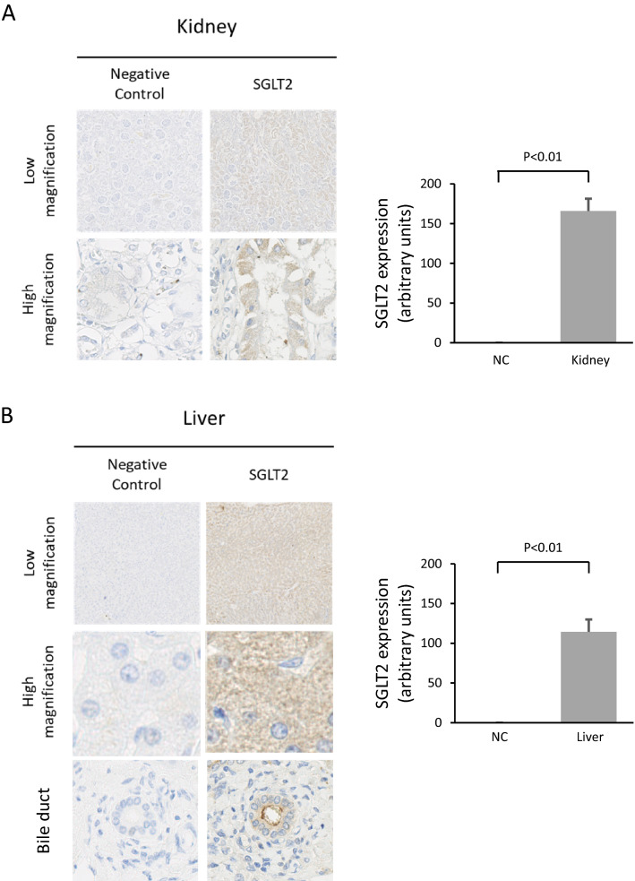 Hepatic expression of sodium-glucose cotransporter 2 (SGLT2) in patients with chronic liver disease.