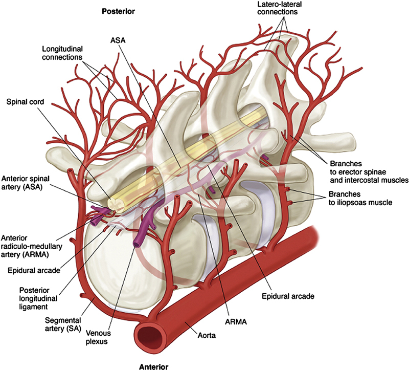 Cerebrospinal Fluid Drainage for Prevention of Spinal Cord Ischemia in Thoracic Endovascular Aortic Surgery-Pros and Cons.