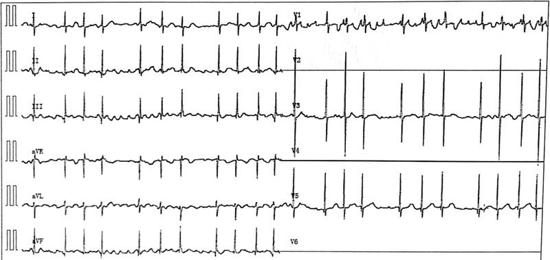 Rett syndrome with atrial tachycardia in a girl.