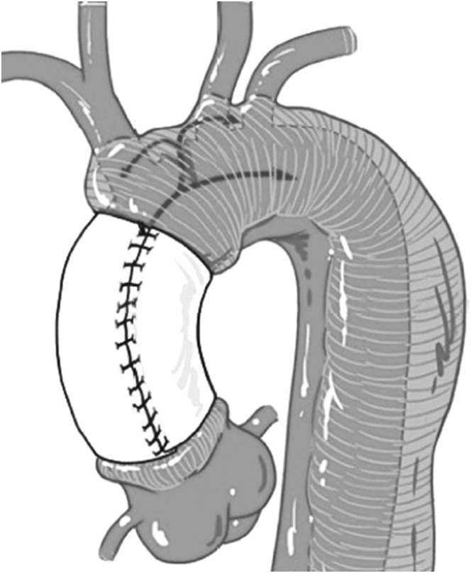 Off-Pump Wrapping for Acute Type A Aortic Dissection: Alternate Option in Patients Deemed Inoperable.